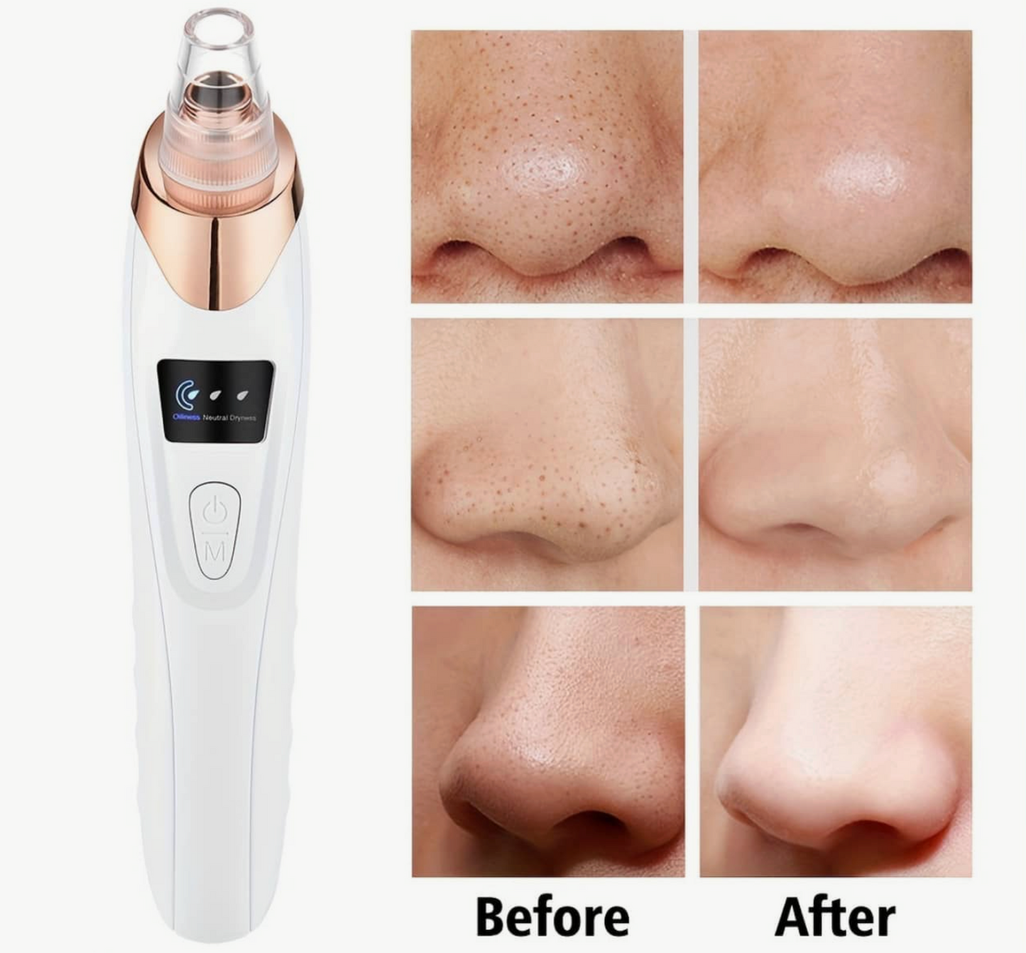 VELORA BLACKHEAD REMOVER™