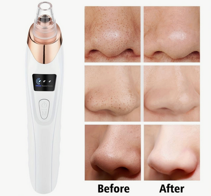 VELORA BLACKHEAD REMOVER™